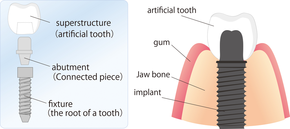 Illustration of all the pieces of dental implants and how they attach in the jaw. 