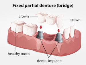 3D image of a cross section of a jaw and how a dental bridge fits into the jaw and surrounding teeth.