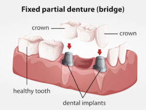 Illustration of all the pieces of dental implants and how they attach in the jaw.