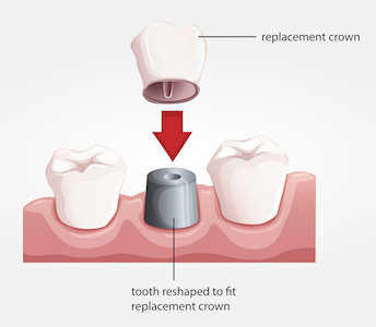 Illustration of a dental crown and how it fits over the existing tooth.